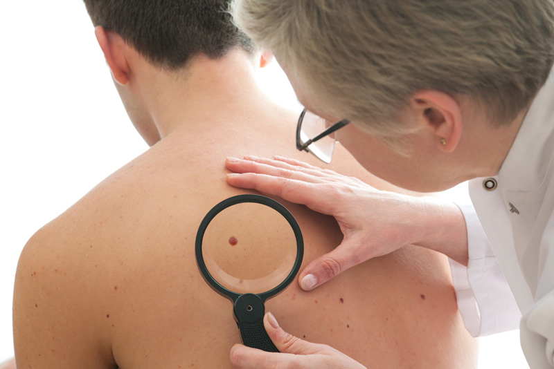 هل تعد الشامات والثآليل علامة على سرطان الجلد؟